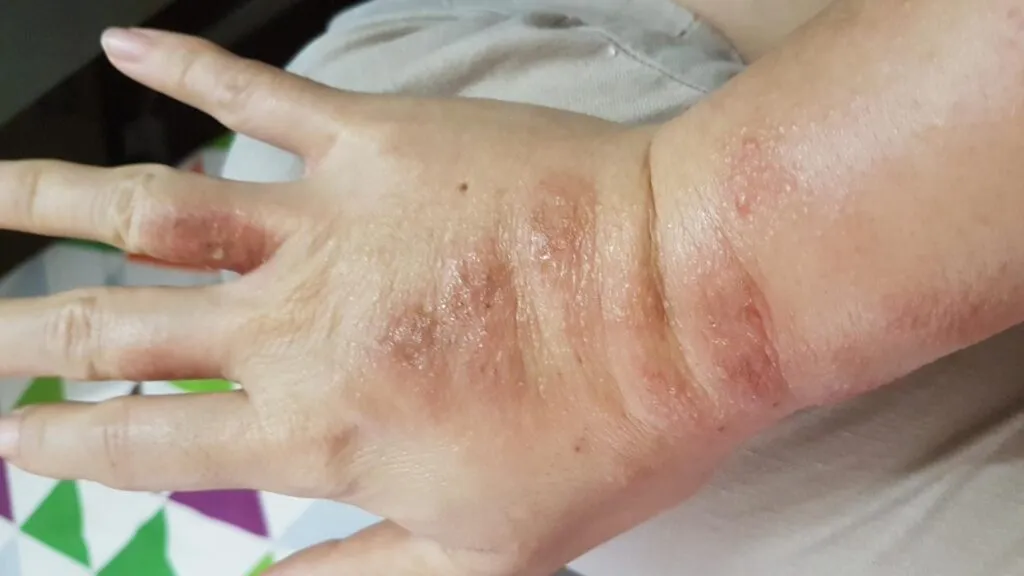 6 June 2017 - My hands started to swell