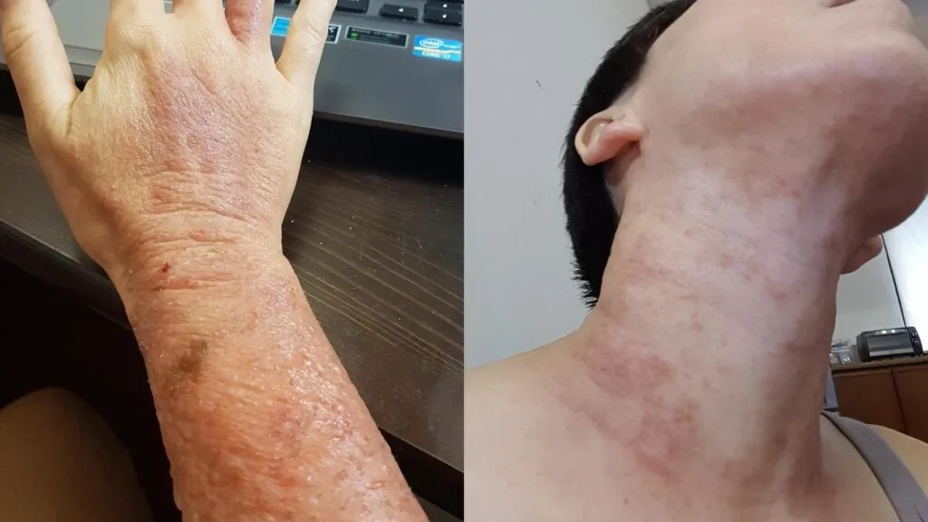 13 June 2017 - Spreading up to my neck area