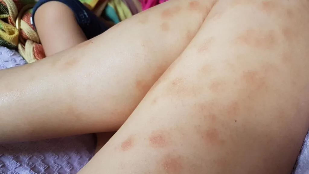 9 July 2017 - Quickly appeared on my legs as well