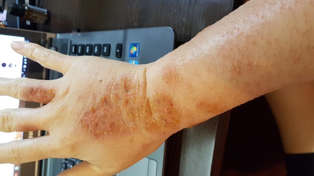 8 June 2017 - "Eczema" quickly spread up my arm
